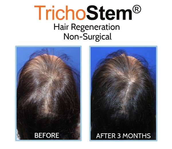 ACell+PRP before and after for women treatment for hair loss