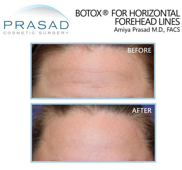 Botox for forehead lines before and after treatment at Prasad Cosmetic Surgery