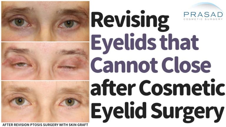 revising eyelids that cannot close after cosmetic eyelid surgery