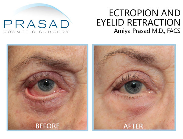 blepharoplasty revision before and after. procedure performed by Dr. Amiya Prasad