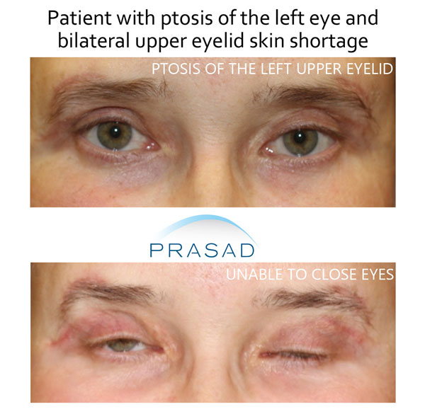 patient needing upper eyelid blepharoplasty revision