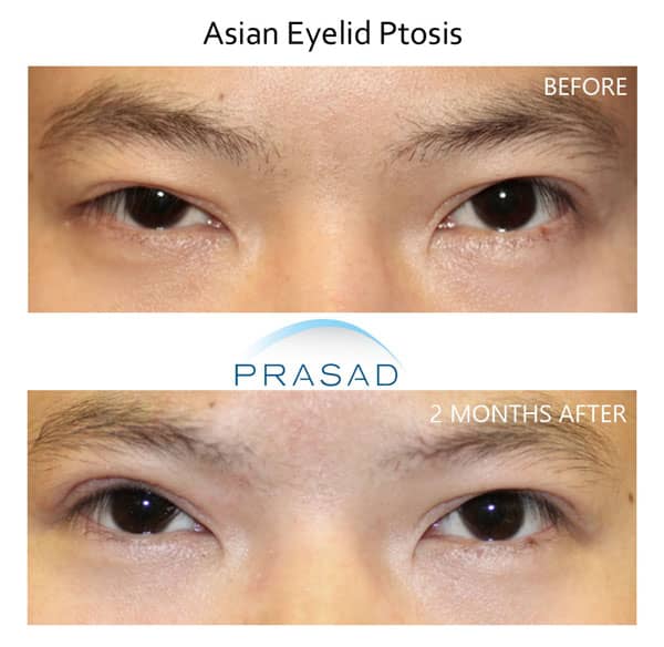 Asian male with ptosis, before and after ptosis surgery by Dr. Amiya Prasad