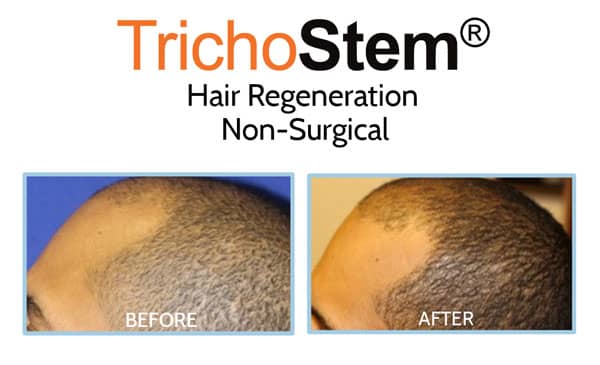 Hair loss at temples on male patient, before and after treatment on hair loss results