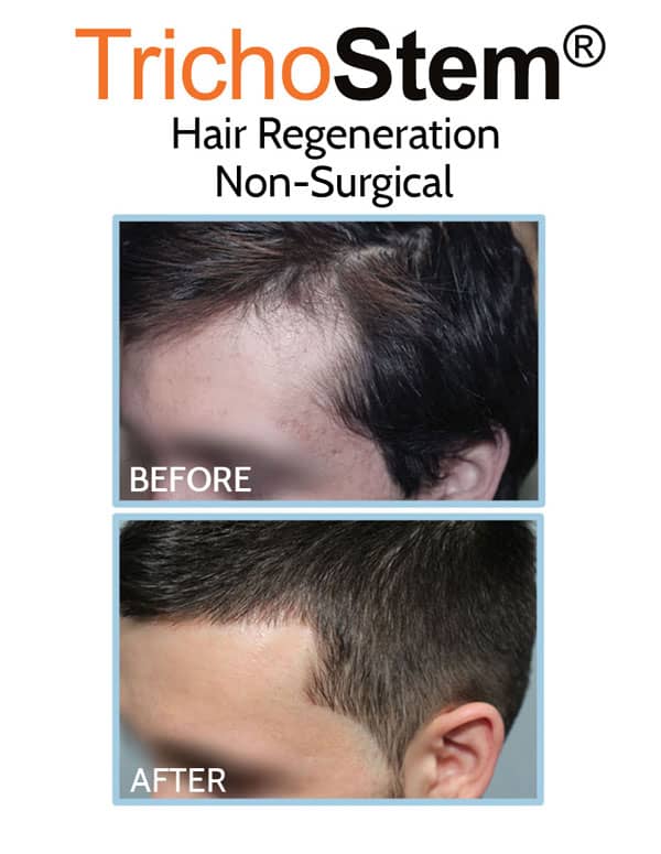 hair loss at front hairline on male patient treated with Trichostem Hair Regeneration - before and after results