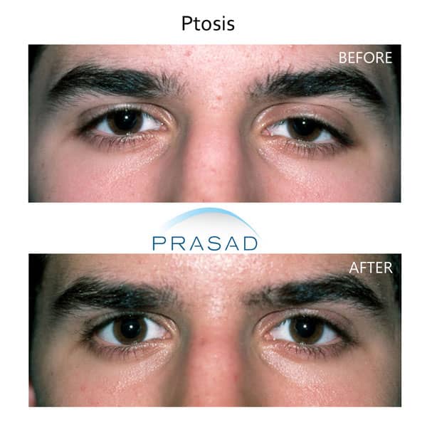 before and after eyelid drooping treatment with ptosis surgery by Dr. Amiya Prasad