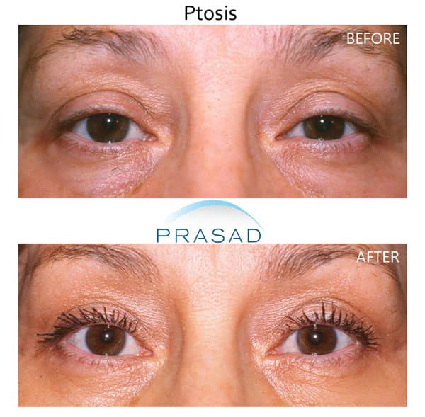 adult female patient with drooping eyelids before and after ptosis surgery