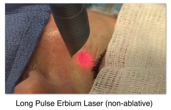 laser eye wrinkles laser treatment at Prasad Cosmetic Surgery New York