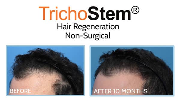 before and after treatment on receding hairline for men