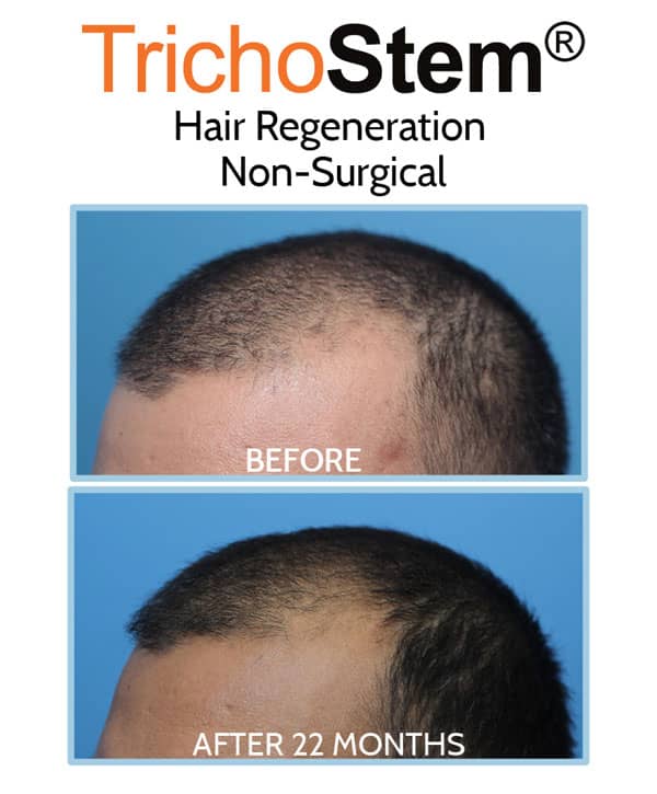 hair thinning at temples on male patient - before and after Hair Regeneration treatment