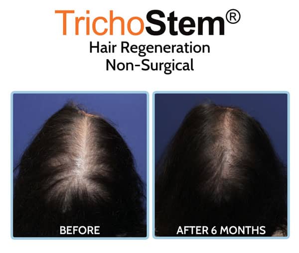 Trichostem Hair Regeneration before and after results on female hair loss