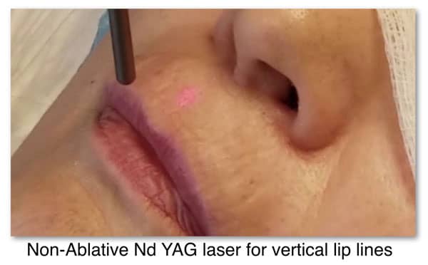 laser for wrinkles treatment at Prasad Cosmetic Surgery