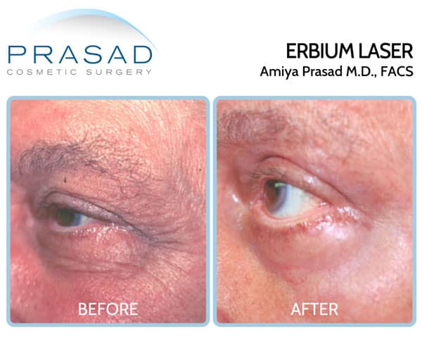 erbium laser for wrinkles around eyes before and after treatment results