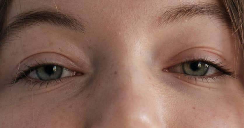 young adult woman with eyelid ptosis
