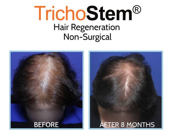 Hair Regeneration for hair loss before and after results on female patient