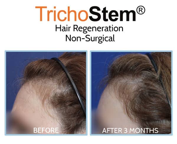 before and after treatment on hair thinning at temples female patient