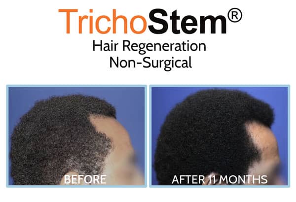 before and after treatment on receding hairline for men