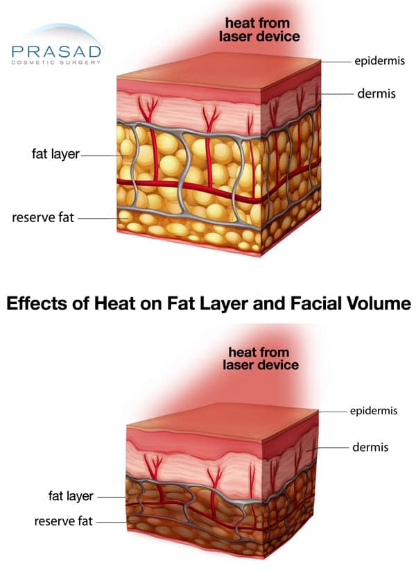 effects of laser heat on facial volume illustration