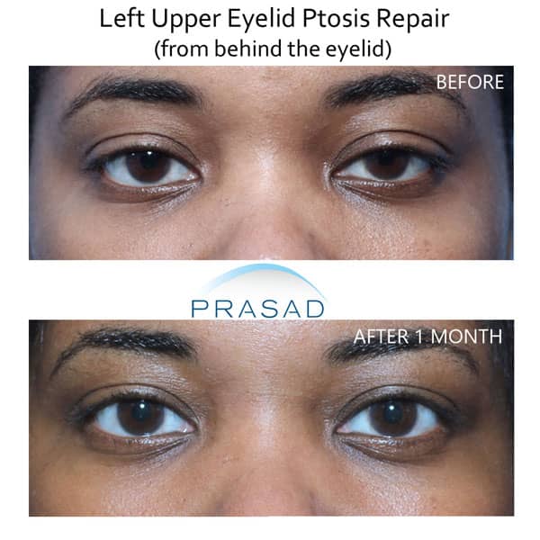 before and after eye drooping treatment on young female patient with dark skin