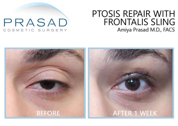 one eyelid drooping treatment with ptosis surgery before and after