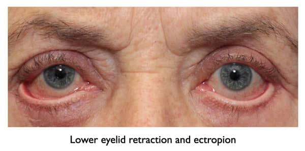 woman with lower eyelid retraction and ectropion after blepharoplasty