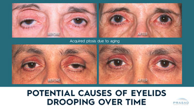 ptosis surgery before and after treatment with the text potential causes of eyelids drooping over time