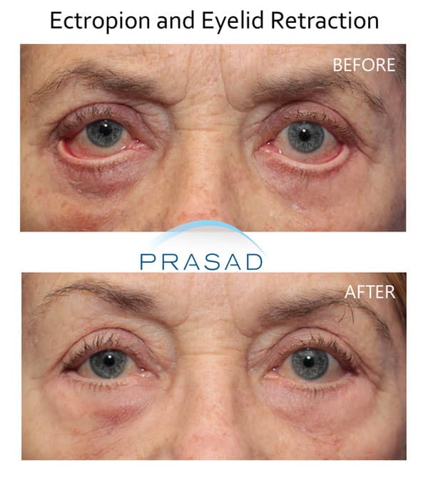 ectropion before and after revision eyelid surgery