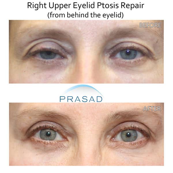 One eyelid drooping treatment, before and after ptosis surgery