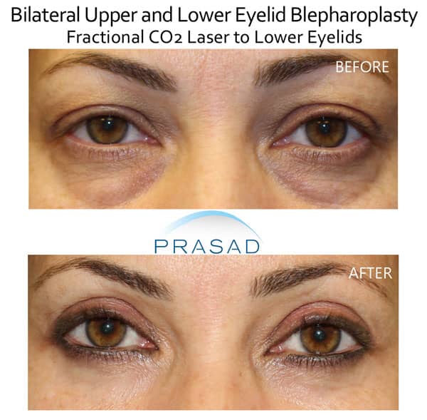 upper and lower blepharoplasty before and after with laser for lower eyelids