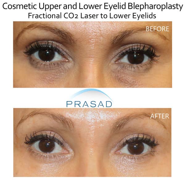 upper and lower blepharoplasty before and after with laser for under eyes