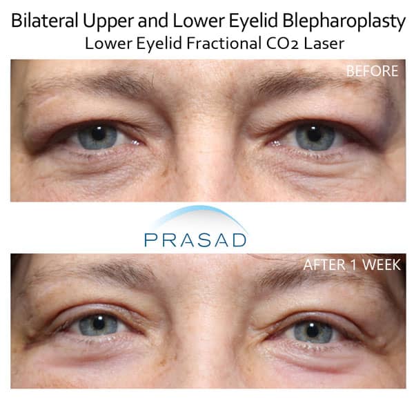 upper and lower blepharoplasty before and after with laser for under eyes treatment