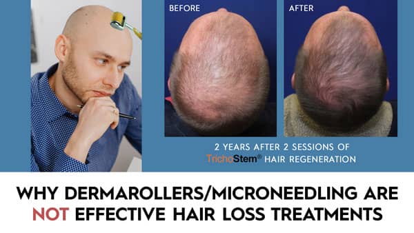 why microneedling are not effective hair loss treatments