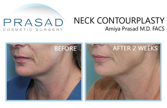 neck contourplasty before and after 2 weeks results on female patient in 60s