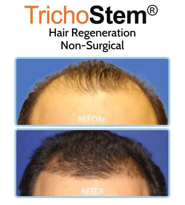 Acell and PRP for hair loss before and after results on male patient with advance hair thinning
