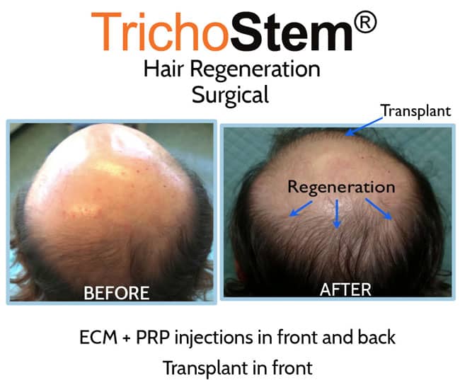 PRP and ACell for Hair Loss before and after treatment results on male patient with advance hair loss