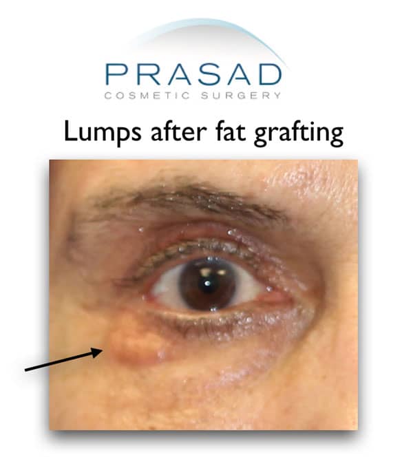 a patient who have lumps after fat grafting