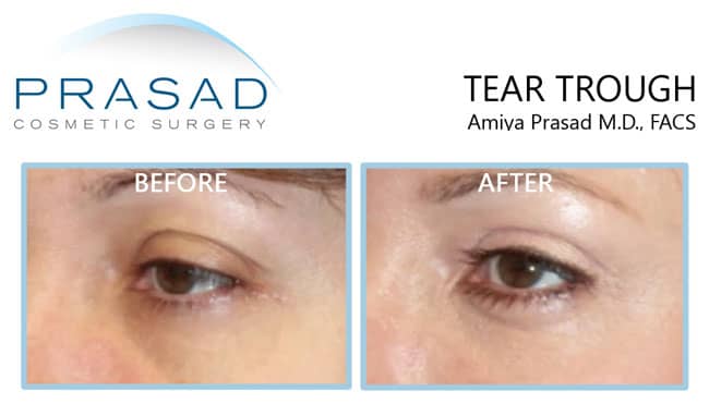 sunken eyes filler before and after treatment results - female patient in 40s