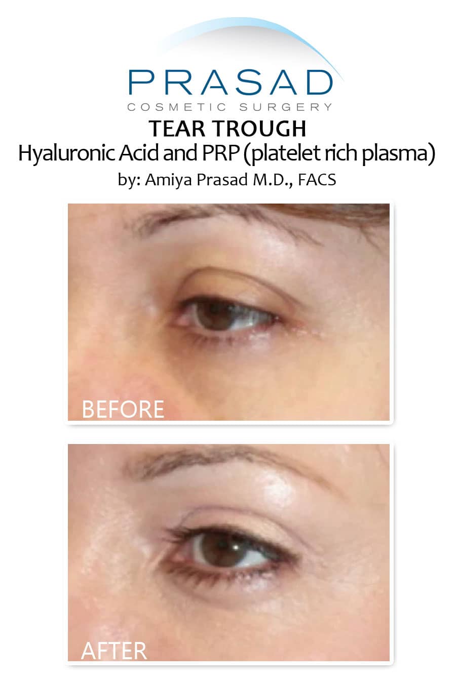 dermal fillers for sunken eyes before and after treatment results on female patient in 40s