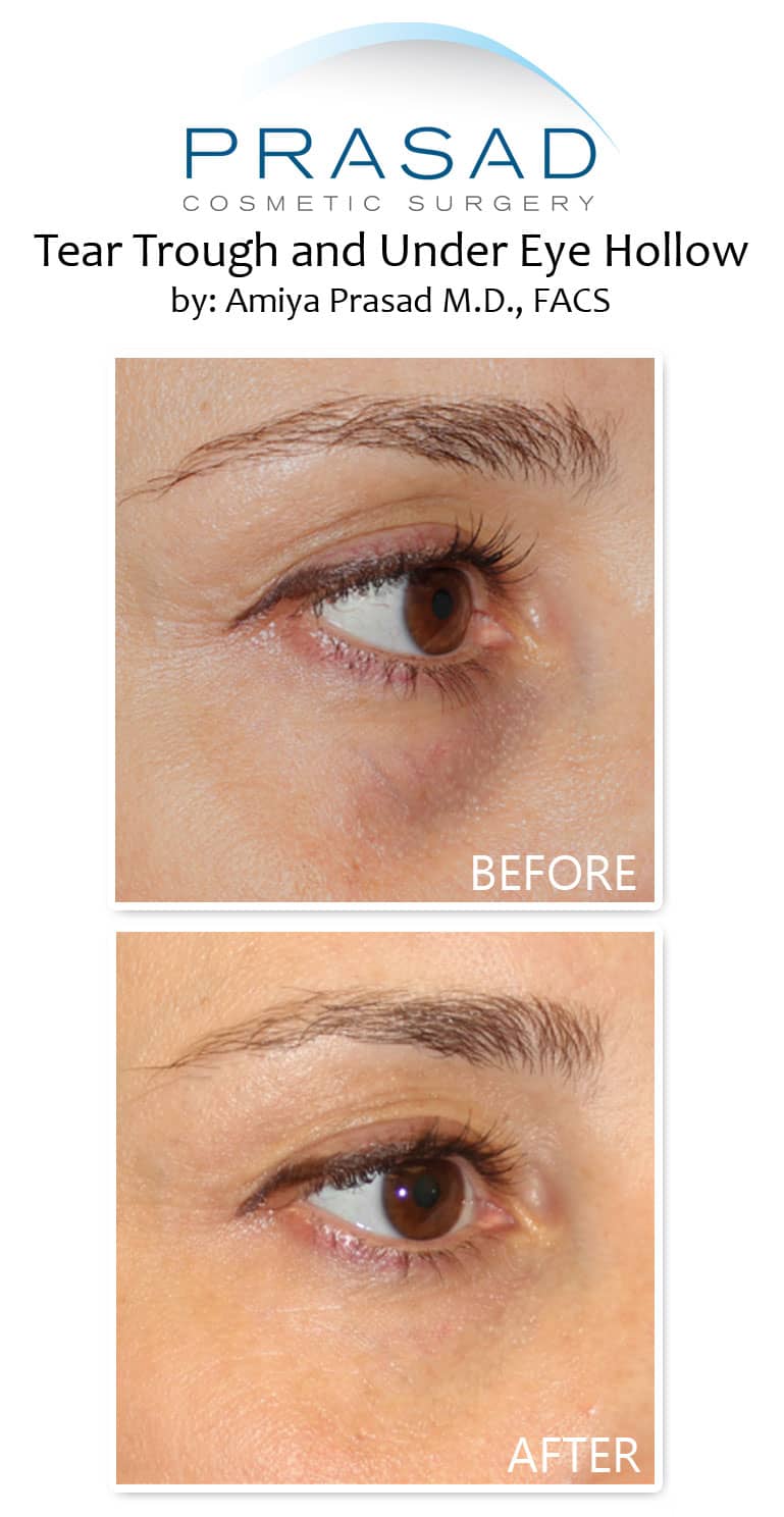 Hollow eyes filler before and after treatment results on female patient in 40s