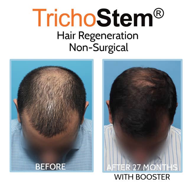 Trichostem Hair Regeneration (PRP and Acell) before and after long term results on male patient in 40s