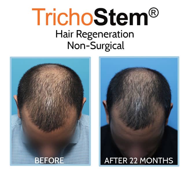 Trichostem Hair Regeneration (PRP and Acell) before and after results on male patient in 40s