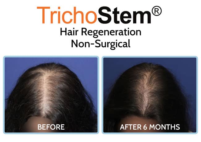 Trichostem Hair Regeneration (PRP and Acell) for women before and after 6 months results