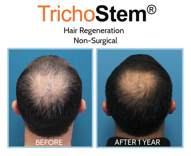 Trichostem Hair Regeneration (PRP+Acell) before and after results on male patient with advance crown thinning
