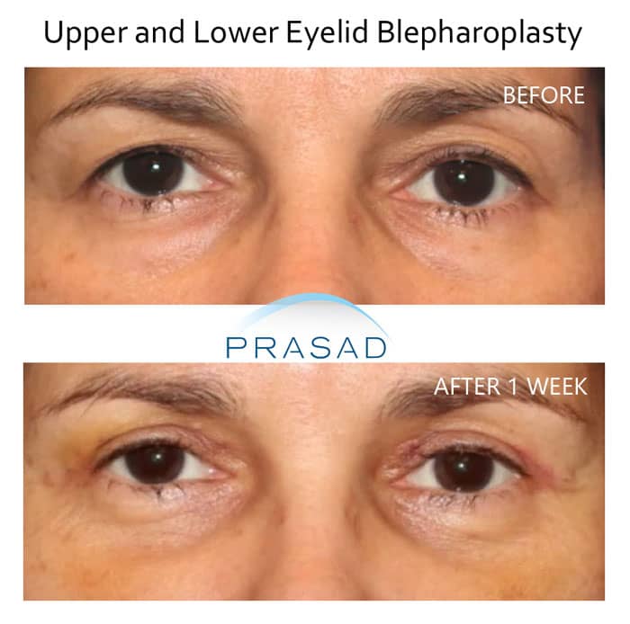 upper and lower eyelid blepharoplasty before and after 1 week recovery using local anesthesia