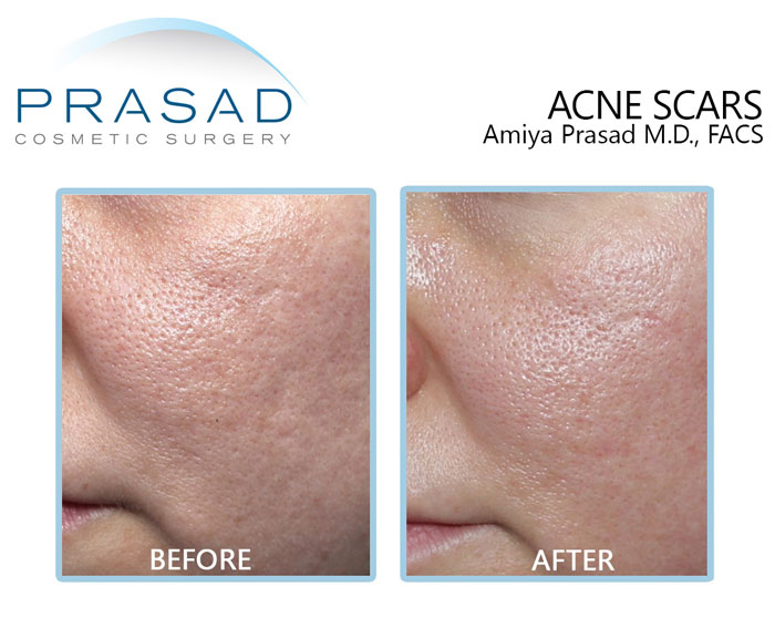acne scar removal treatment before and after at Prasad Cosmetic Surgery