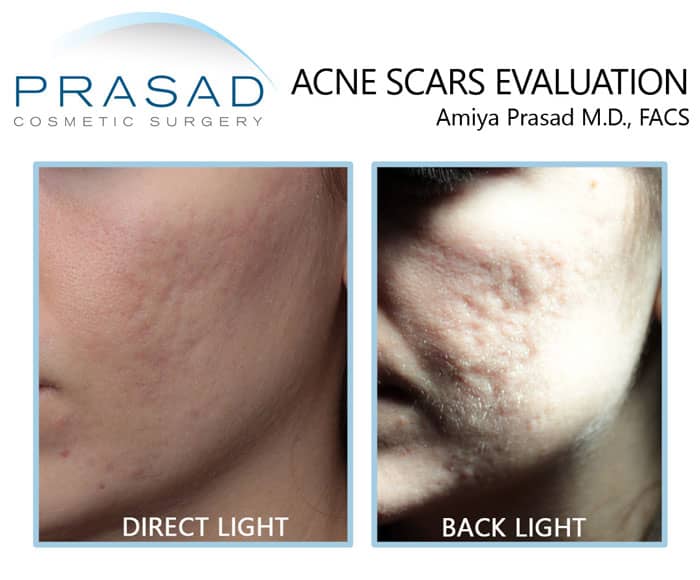 acne scars evaluation at Prasad Cosmetic Surgery New York