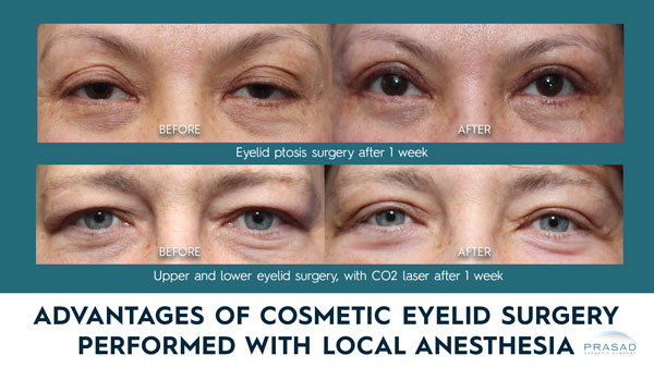 advantages of cosmetic eyelid surgery performed with local anesthesia