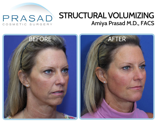 facial rejuvenation before and after on female in 40s