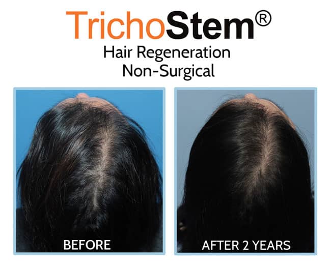 Trichostem Hair Regeneration (Acell with PRP) for female hair thinning before and after results