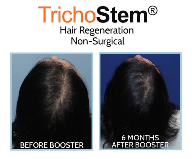 Trichostem Hair Regeneration (Acell and PRP) for female hair loss before and after booster results