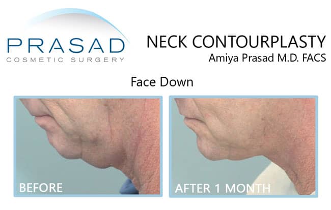 neck contourplasty on male patient before and after results
